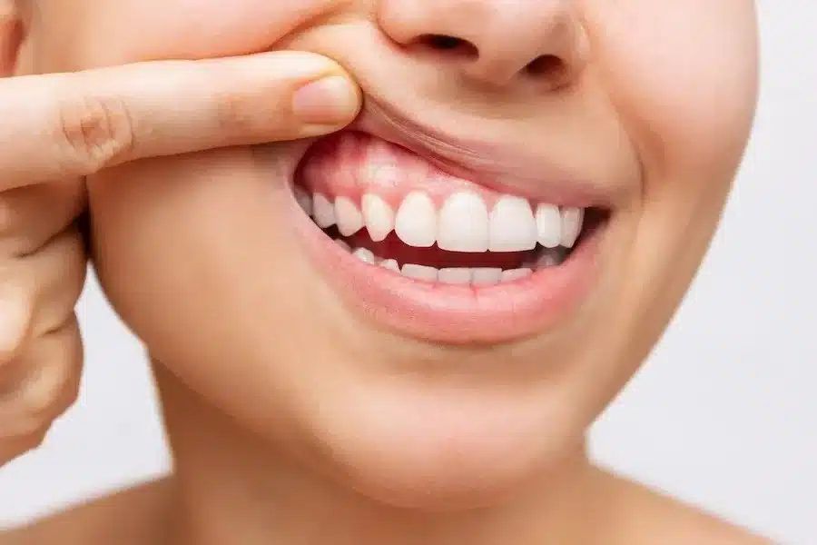Gums Healthy