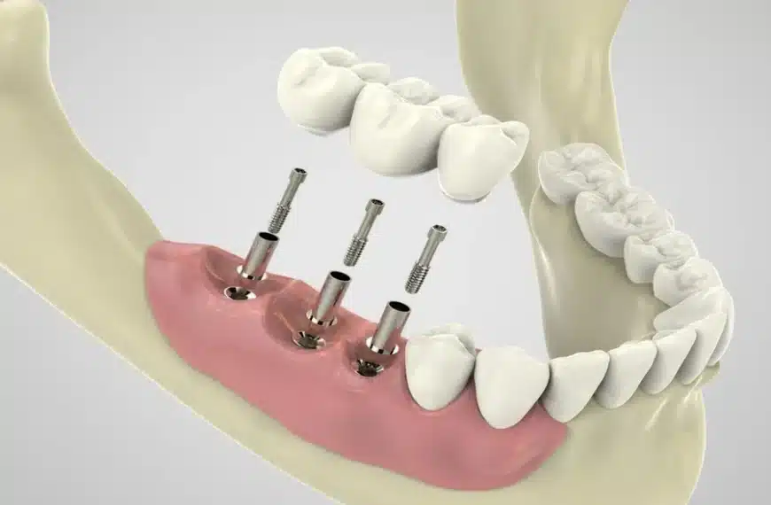Implant Dentistry