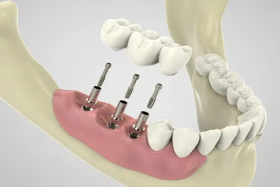 Implant Dentistry