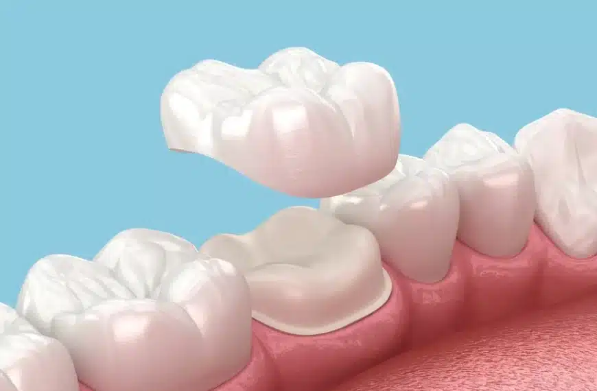 Crowning Teeth