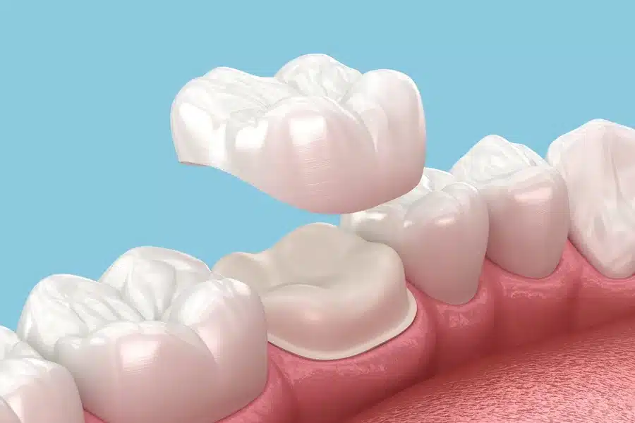 Crowning Teeth