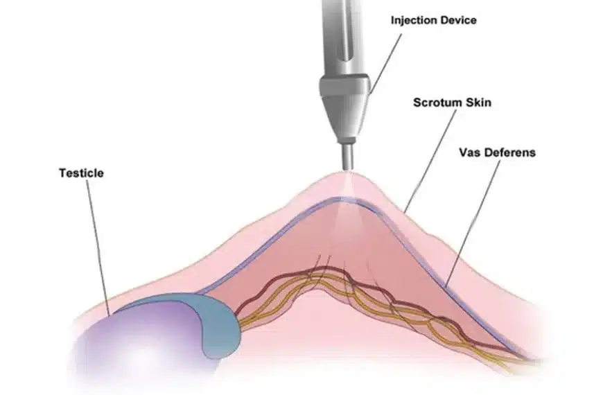 s a Painless Vasectomy Possible? Here’s What Modern Procedures Offer