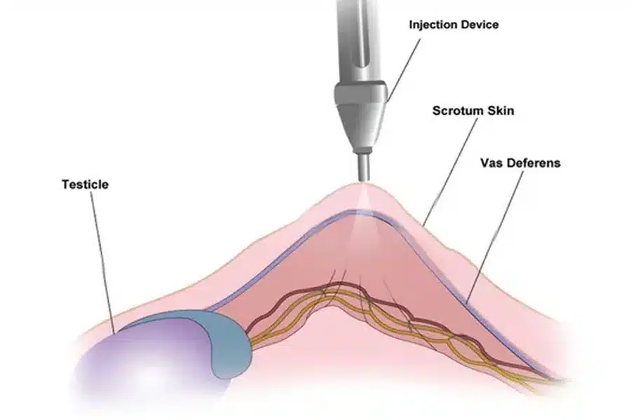 s a Painless Vasectomy Possible? Here’s What Modern Procedures Offer