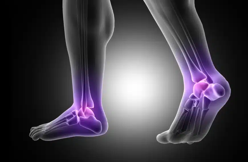 Ankle Fractures