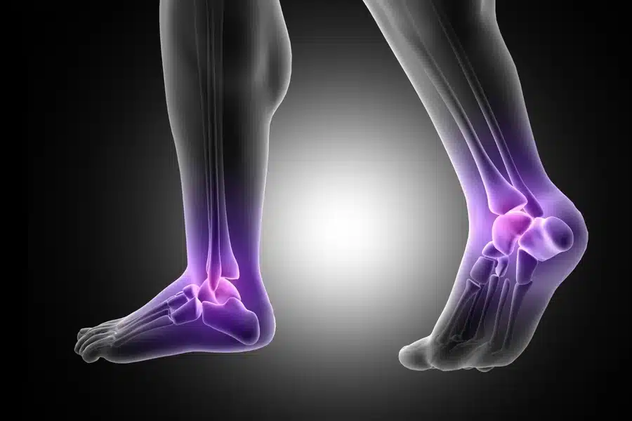 Ankle Fractures