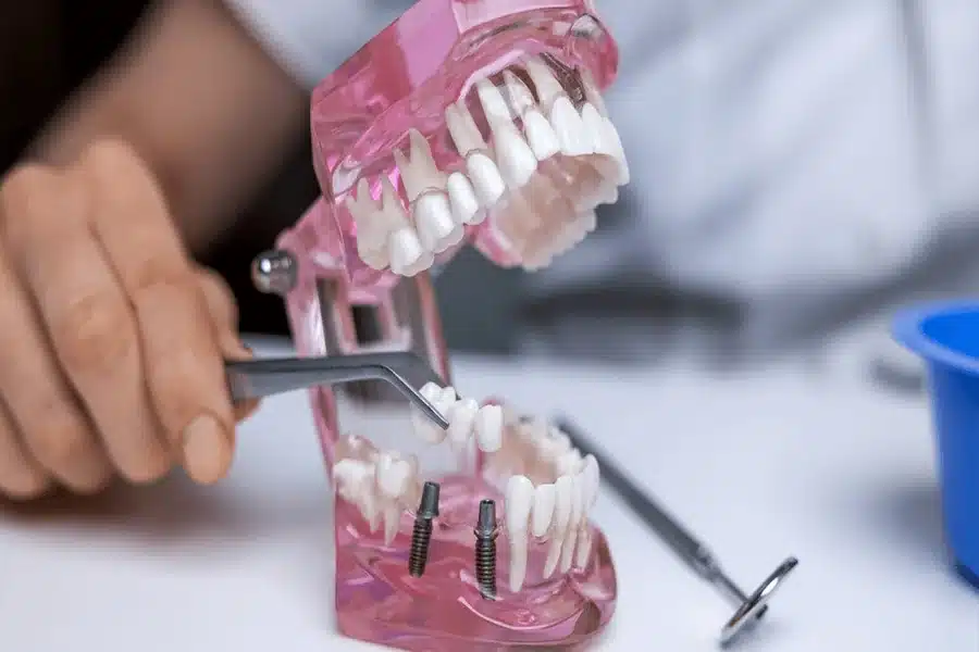 Dental Implants