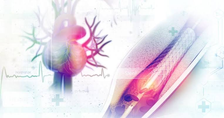 Does Health Insurance Cover Angioplasty and Severe Cardiovascular Conditions?