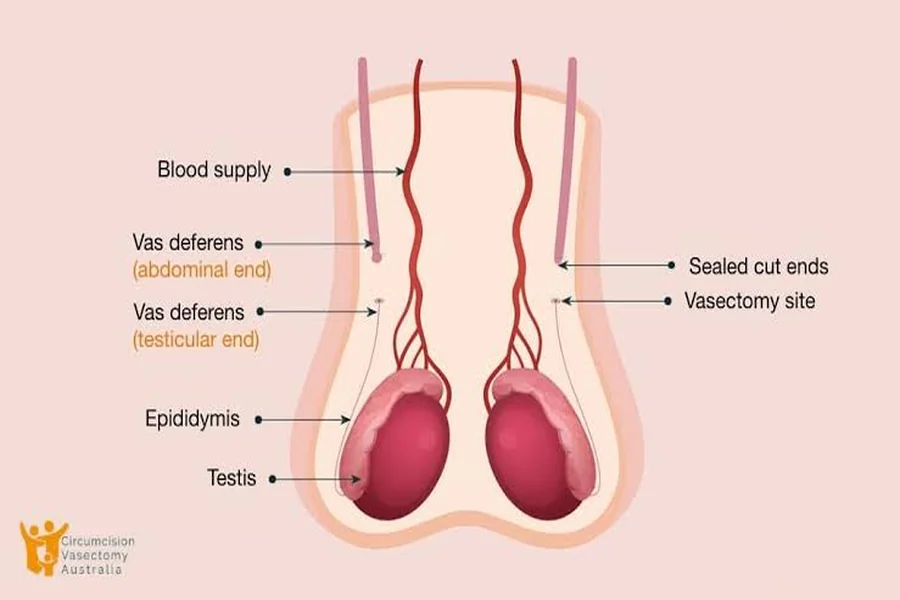 Understanding Vasectomy Procedures and Services in Melbourne